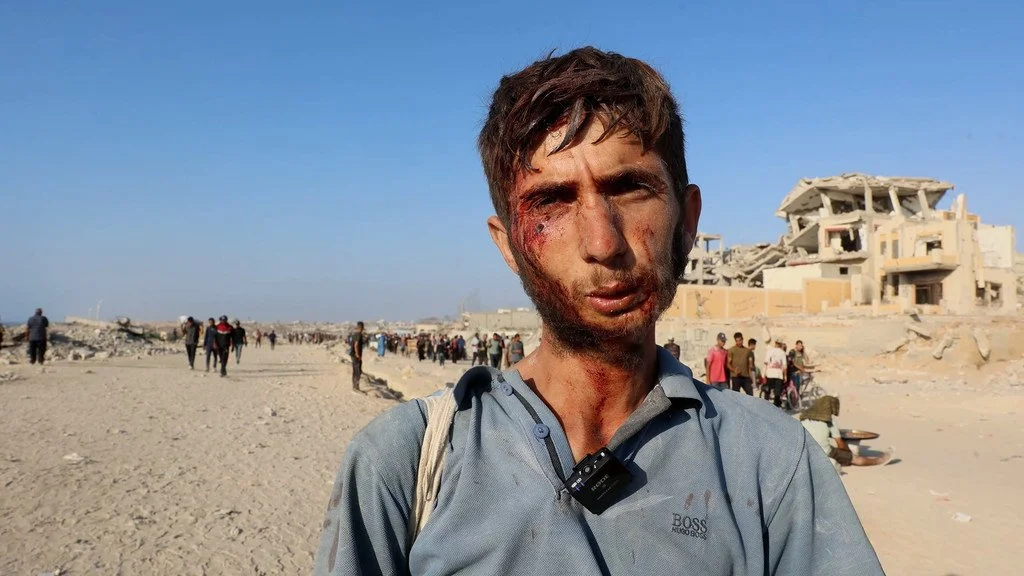  Noticias ONU Un joven gazatí herido en la cara mientras intentaba obtenera ayuda humanitaria. 